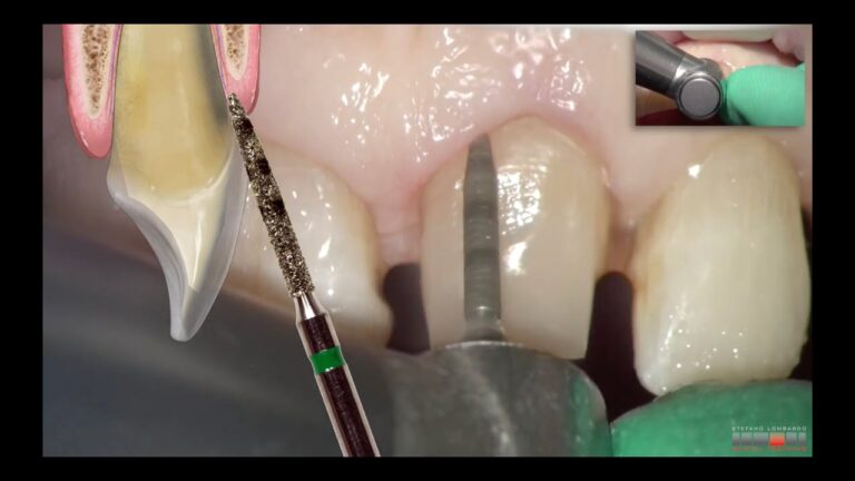 Preparacion dental con la Tecnica BOPT (biologically oriented preparation technique)