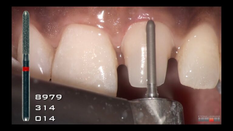 Tecnica de Preparacion de Chamfer para Corona Dental de Ceramica Paso a paso