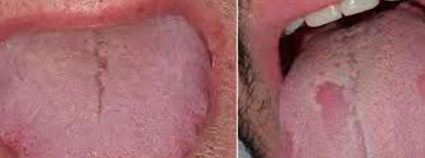 lengua-covid-19-sintomas-orales