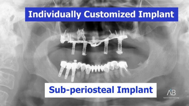 Implante personalizado individualmente: implante subperióstico con una gran pérdida ósea
