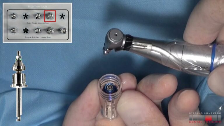 Cirugía guiada de implante dental para molar inferior: Guía Real paso a paso