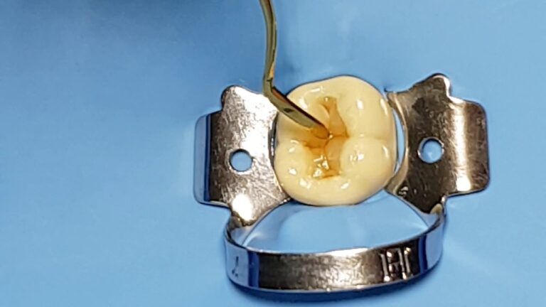 Restauración de resina compuesta- composite dental- clase I en molar, paso a paso