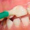 barniz-de-fluor-dentaltvweb
