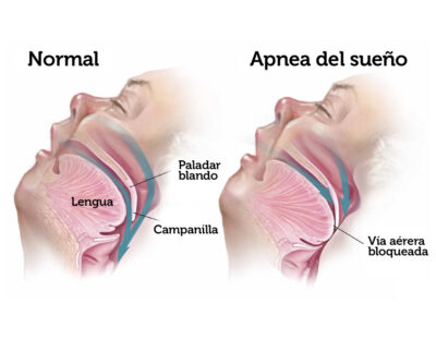 apnea