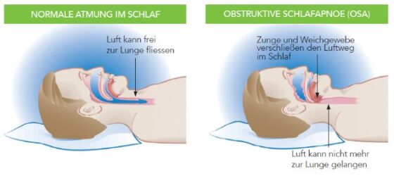 Schlafapnoe