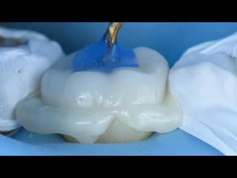 CERAMIC EMAX OVERLAY – All steps and all tips and trick from prep to delivery