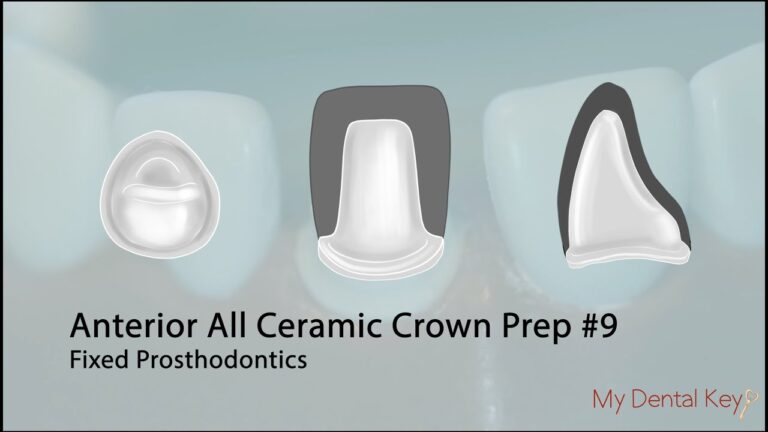 PASS THE CDCA – All Ceramic Anterior Crown Preparation