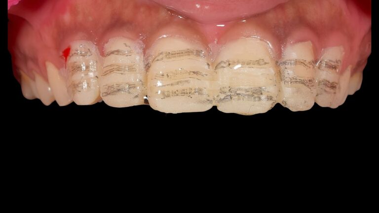 Step by Step Veneer Preparation And Cementation | EMAX Porcelain Veneer | Clinical case
