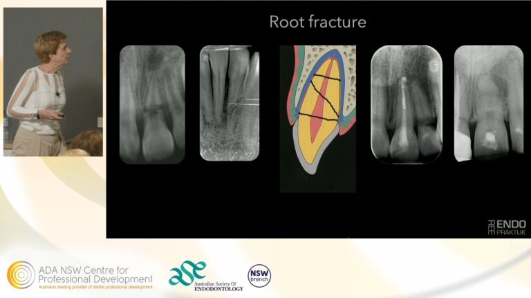 Dental trauma 3, root fractures