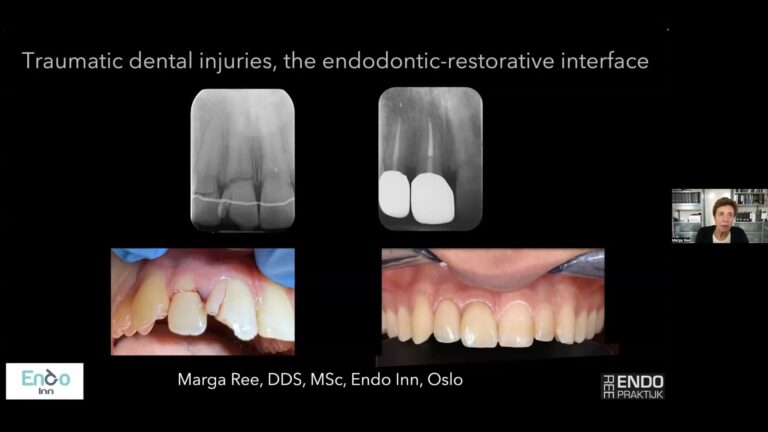 Dental trauma 4, the endo-restorative interface