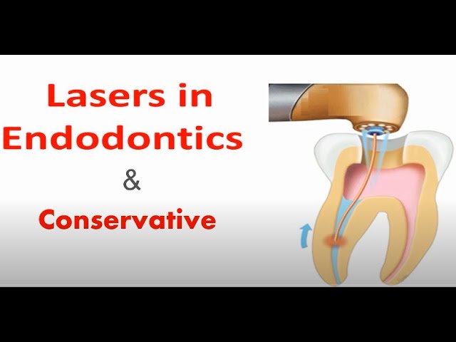 LASERS IN ENDODONTICS AND CONSERVATIVE DENTISTRY