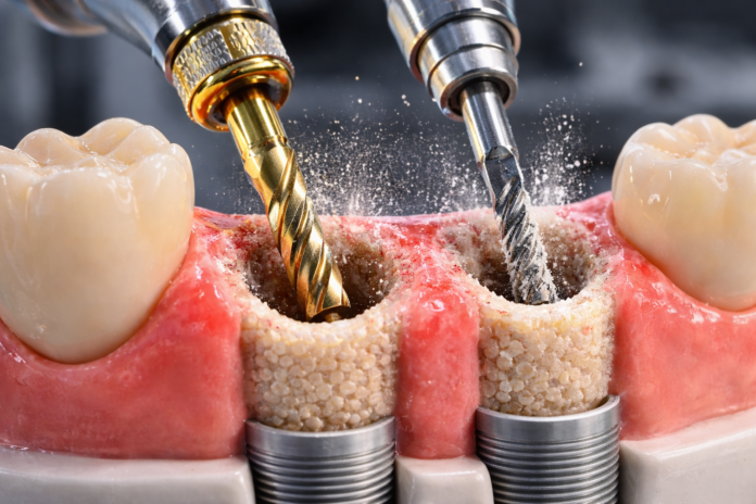 Preparación del lecho implantario comparando osseodensificación y fresado convencional en un modelo dental con implantes.