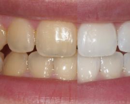blanqueamiento dental