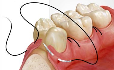cirugia dental
