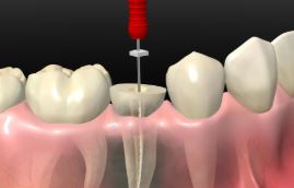 endodoncia