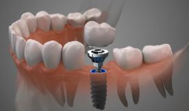 implantes