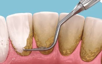 periodoncia