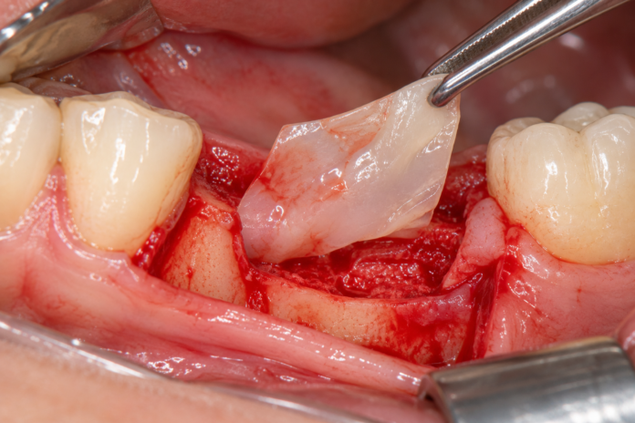 Colocación de membrana periodontal
