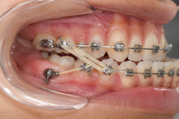 Elásticos y Brackets en Corrección Ortodóntica