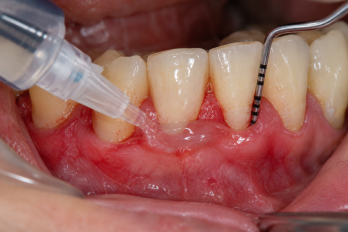 Procedimiento periodontal con gel en encías