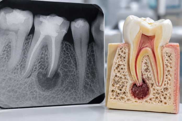Radiografía y modelo dental con lesión radicular