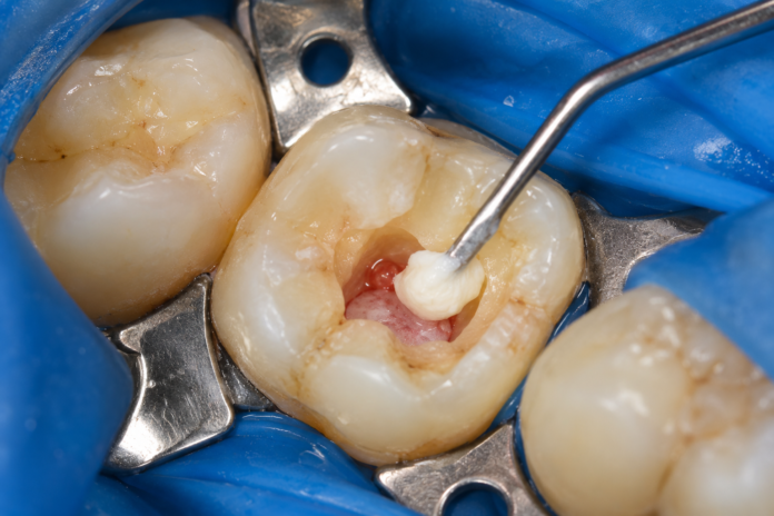 Restauración dental bajo dique de goma